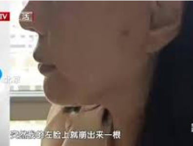 女子线雕手术三年后脸上钻出一根线