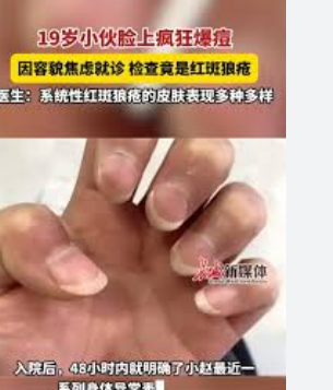 19岁小伙脸上爆痘竟是红斑狼疮