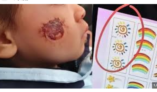 <strong>3岁女童脸部贴贴纸致皮肤糜烂</strong>