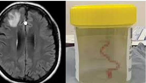 <strong>61岁女子脑内取出8厘米活虫</strong>