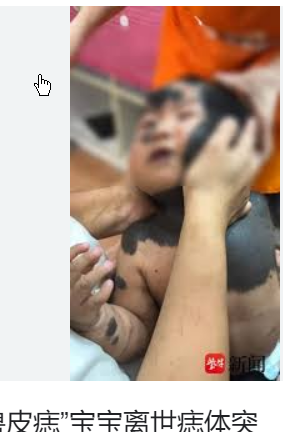 <strong>2岁兽皮痣患儿因痣体癌变离世</strong>